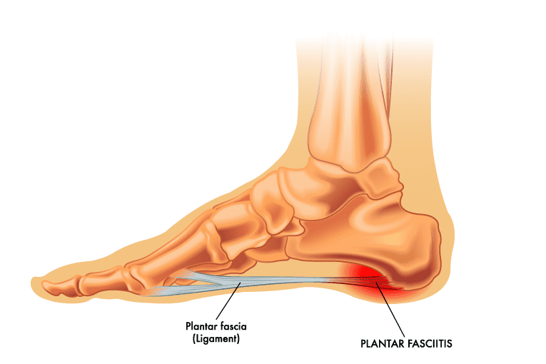 sharp pain heel of foot